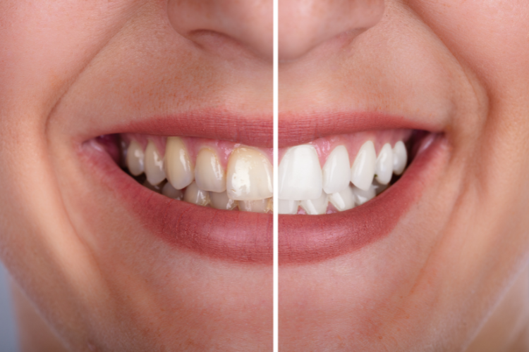 Brighten Your Smile with Professional Teeth Whitening in Birkdale at The Dental Project