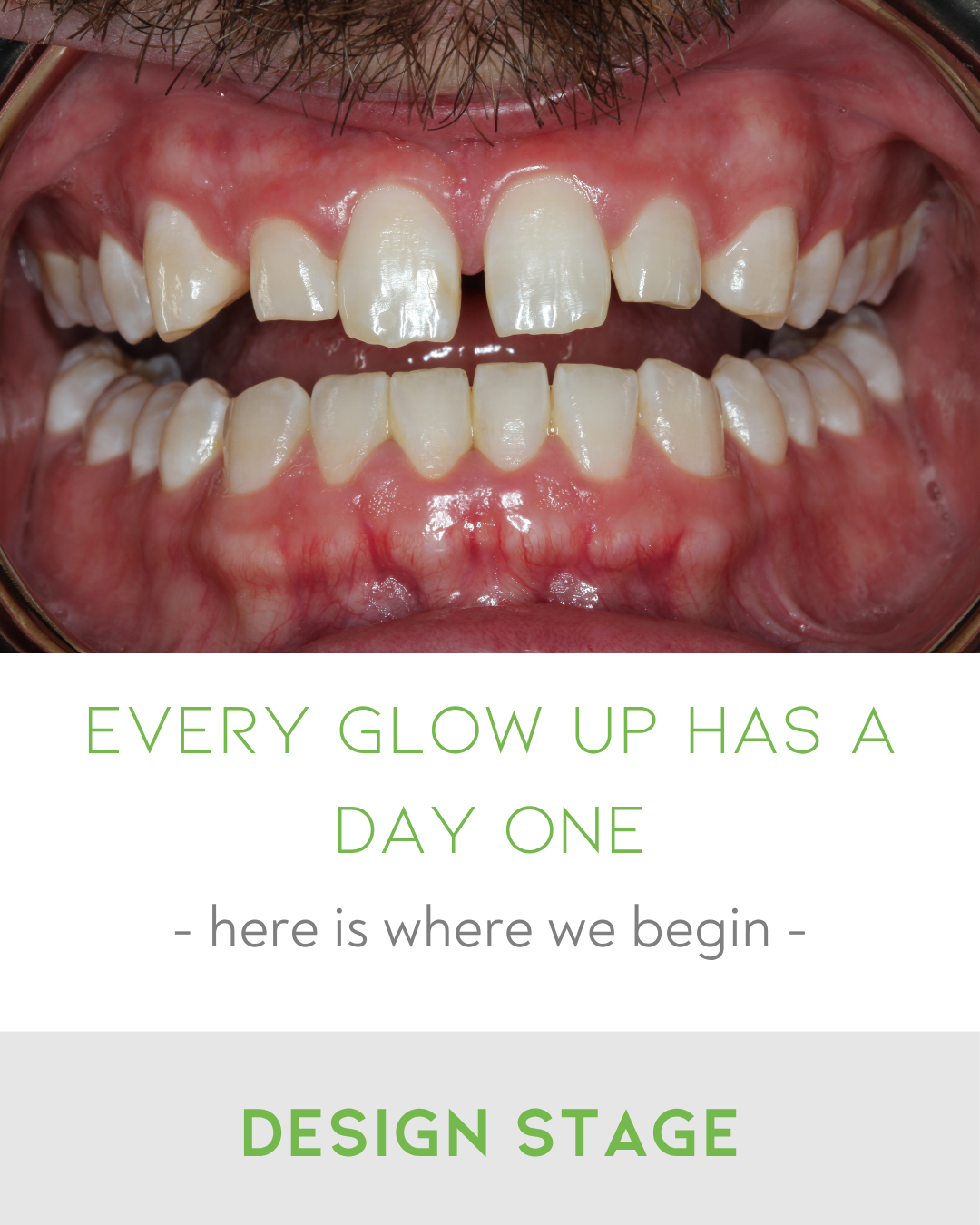 Clear Aligners in Thorneside