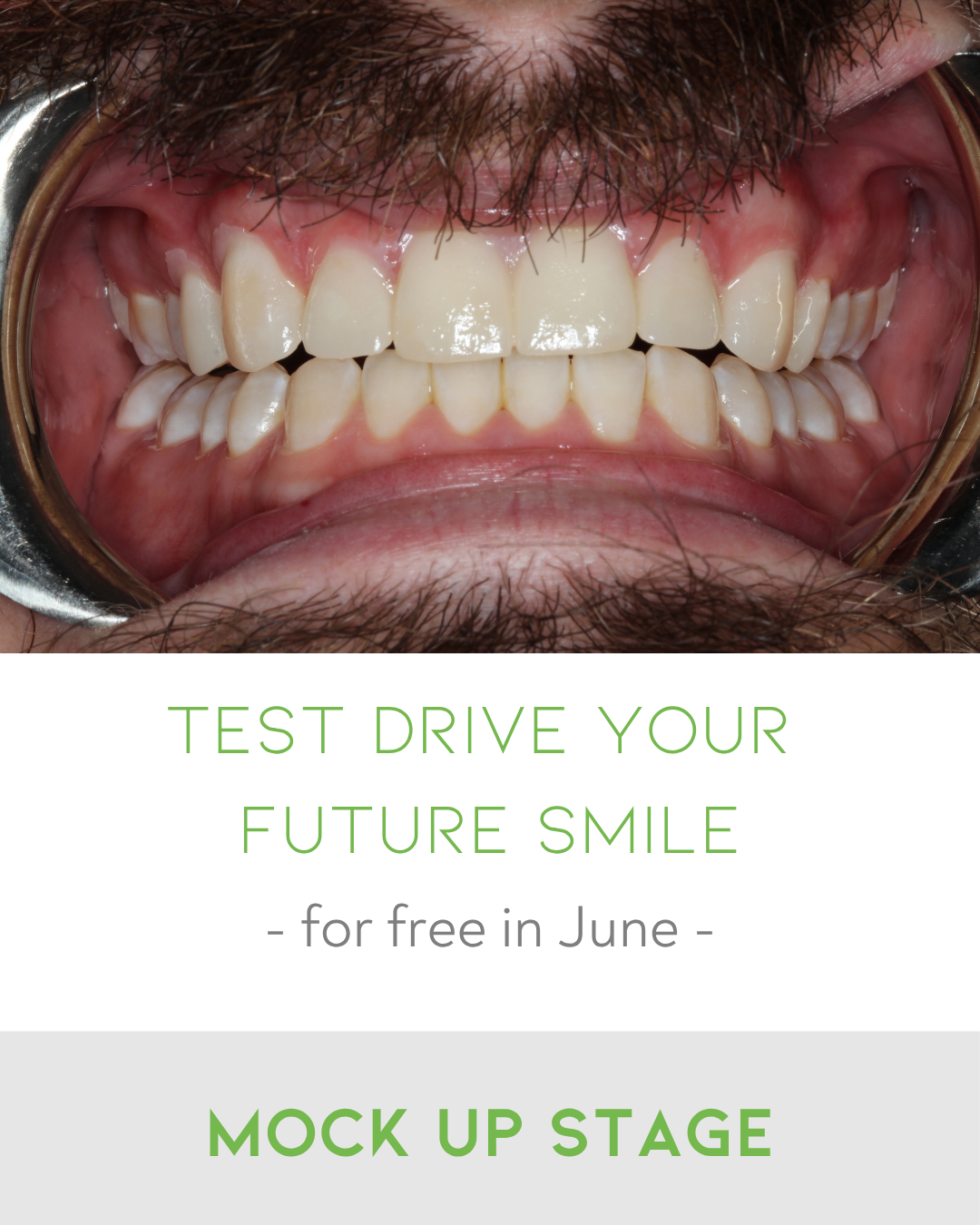 Clear Aligners in Thorneside