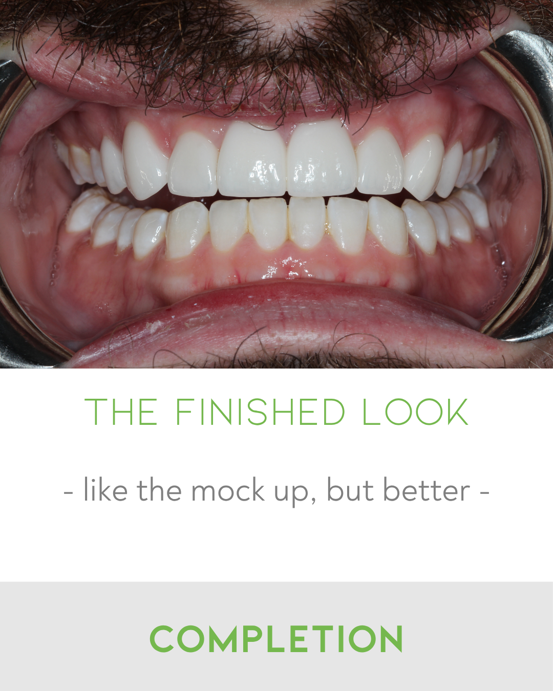 Clear Aligners in Thorneside