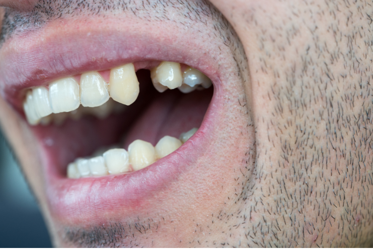 Dental Implants Ormiston