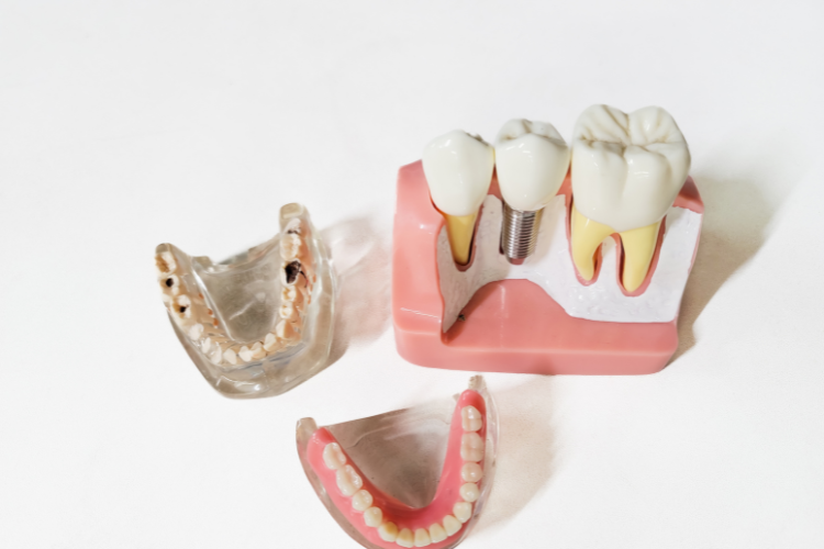 Dental Implants Thorneside