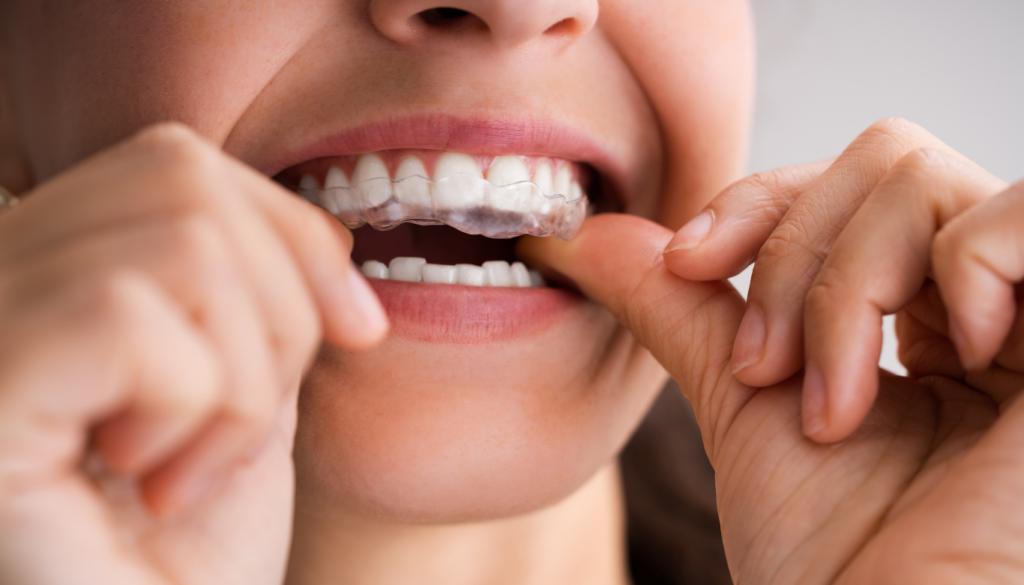 Close-up of hands placing a clear orthodontic aligner over the upper teeth during a dental adjustment.